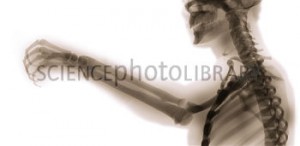 C0115766-Boxing_pose,_X-ray-SPL