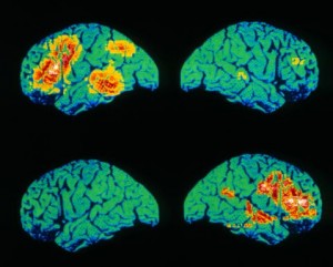 Colour PET scan of language areas of the brain