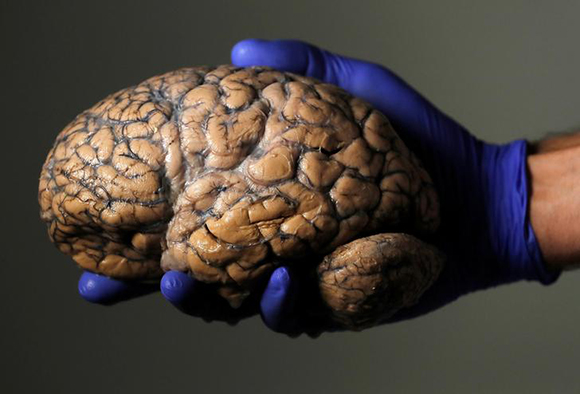  Belgian researcher Jeroen Schuermans holds a human brain, part of a collection of more than 3,000 brains that could provide insight into psychiatric diseases, at the psychiatric hospital in Duffel, Belgium, July 19, 2017. Photo by Yves Herman