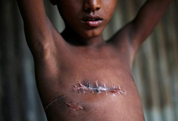  Mohammed Shoaib, 7, who was shot on his chest before crossing the border from Myanmar in August, shows his injury outside a medical centre after seeing a doctor, at Kutupalong refugee camp near Cox’s Bazar, Bangladesh. Photo by Adnan Abidi 