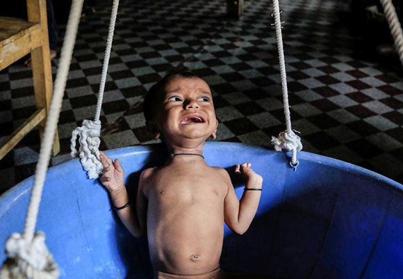  Sufated, a 10-month-old malnourished Rohingya boy, cries while being weighed at the Action Against Hunger center in Kutupalong refugee camp near Cox's Bazar, Bangladesh. Photo by Zohra Bensemra 