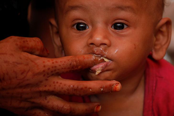  A malnourished child is fed at UNICEF medical centre at Balukhali refugee camp near Cox's Bazar, Bangladesh. Photo by Damir Sagolj 