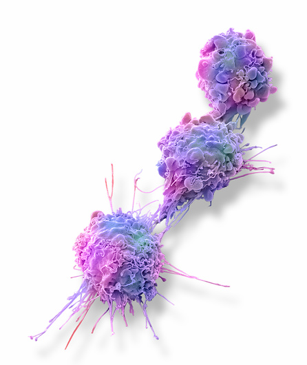 Ovarian cancer cells, SEM